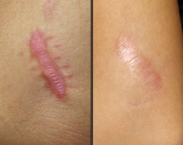 silicon scar removal stick